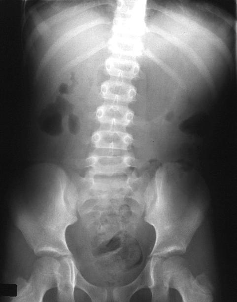 hernias in children. its causes become paediatric hernia Inguinal+hernia+symptoms+in+children