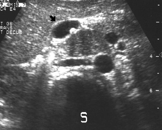 abnormal gallbladder ultrasound images. upper quadrant ultrasound