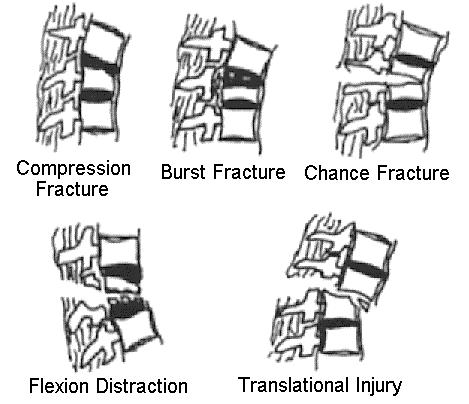 compression fractures