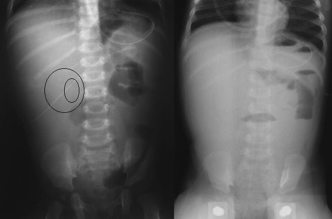 Intussusception X Ray
