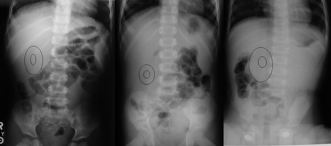 Target Sign Intussusception