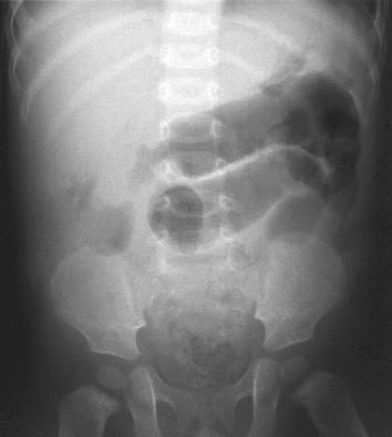 Radiology In Ped Emerg Med Vol 1 Case 2