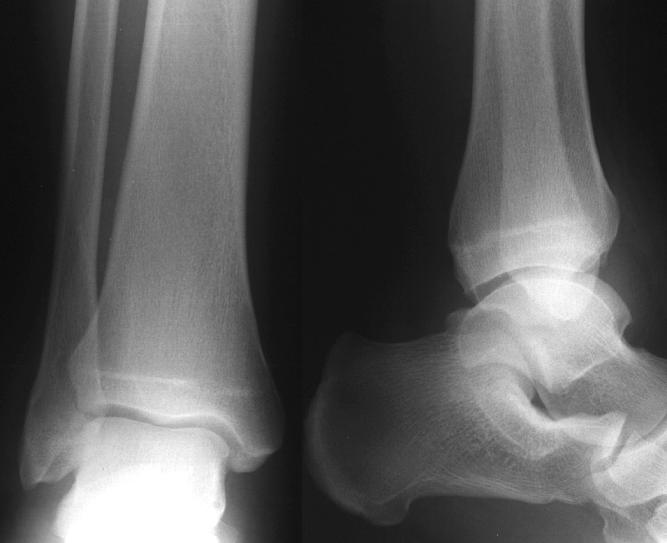 sprained ankle x ray