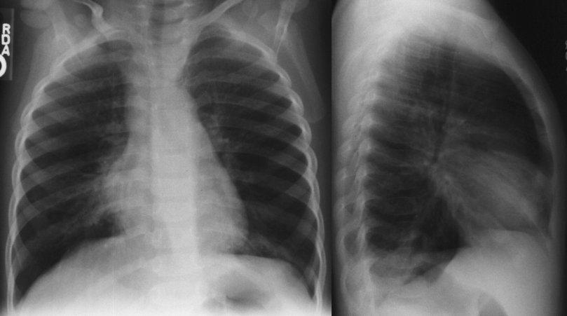 Bilateral bronkopneumonia Pneumonia, Bronkopneumonia