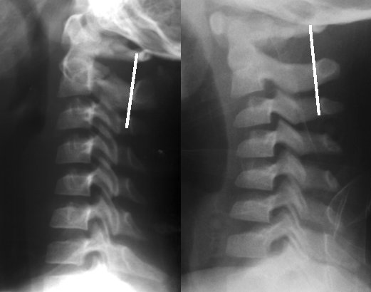 Odontoid and hangman fracture