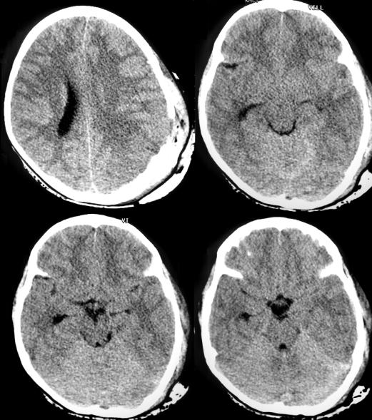 Hemorrhage intracranial subdural vs hematoma The Radiology