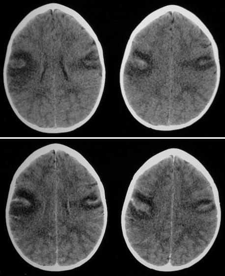 Featured image of post Cerebritis Ct Brain See more ideas about radiology radiology imaging neurology