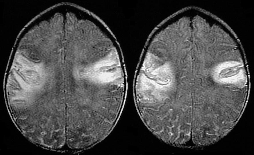 Featured image of post Cerebritis On Mri A severe untreated sinus infection may lead to cerebritis is the definite diagnosis after mri testing