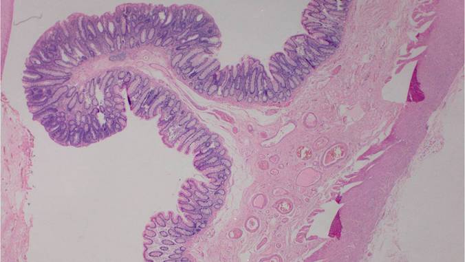 colon polyp microscope image