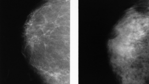 breast imaging