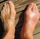 Native Hawaiians more at risk for gout, UH study reveals
